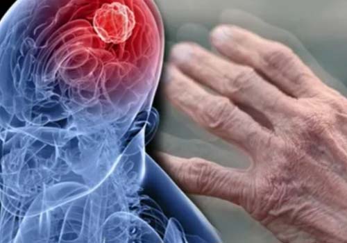 Kidney Stone Treatment